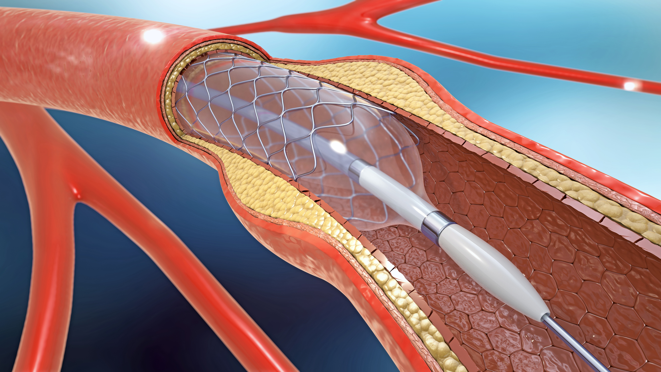 Mitt Voorschrift Storing Coronary Balloon Angioplasty - Advanced Heart and Vein Center
